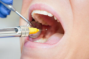 Cosmetic Micro Dentistry | Veneers, X-Guide   by X-Nav and Dental Cleanings