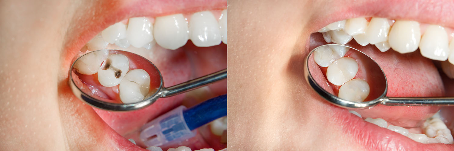 Cosmetic Micro Dentistry | Periodontal Treatment, Dental Fillings and Pediatric Dentistry