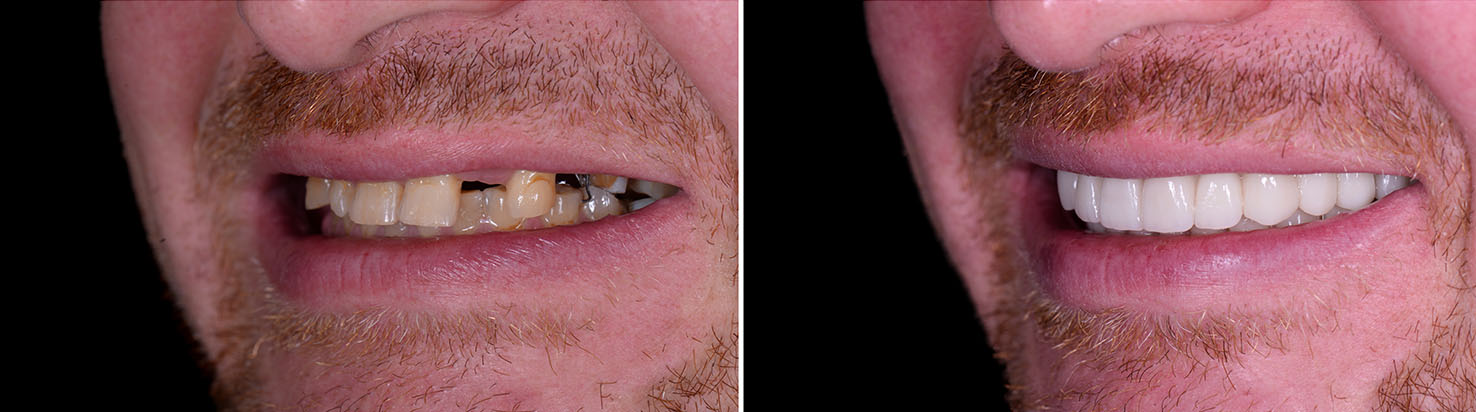 Cosmetic Micro Dentistry | Pediatric Dentistry, Inlays  amp  Onlays and Dentures